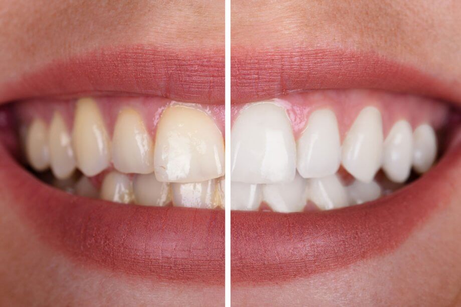 Befor and after result for our teeth whitening strips 
