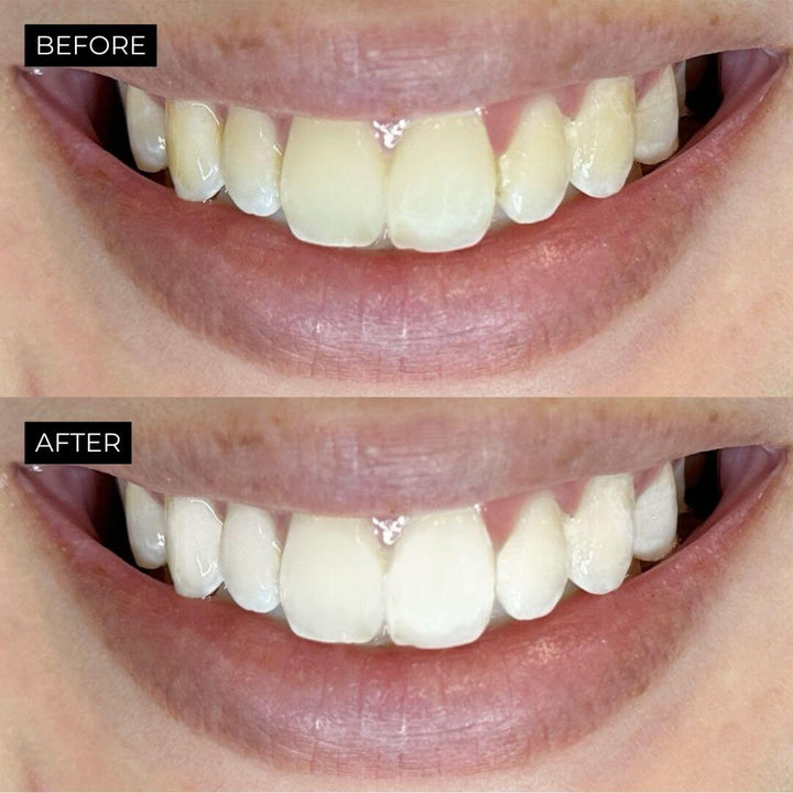 before and after photos using advanced teeth whitening strips for stained teeth
